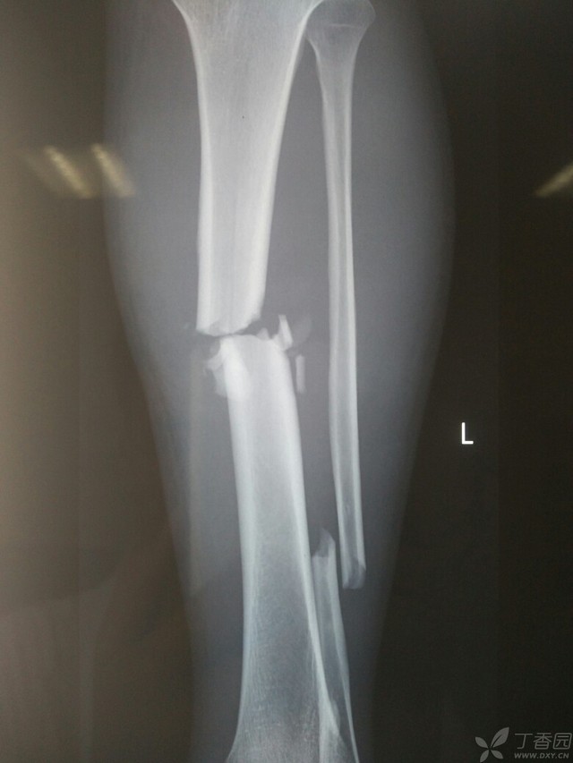 科技重塑脛腓骨骨折康復之旅，引領(lǐng)未來(lái)體驗新篇章