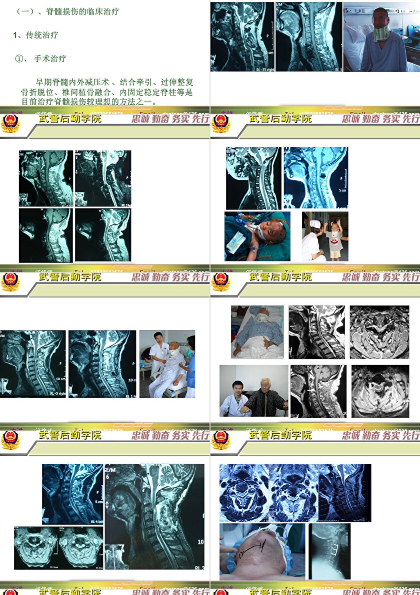 2023年脊髓損傷研究新進(jìn)展，里程碑式的突破與日常奇妙變化