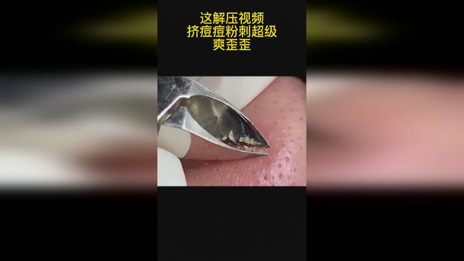 最新擠膿包視頻，見(jiàn)證變化的力量，自信與成就感的誕生之地